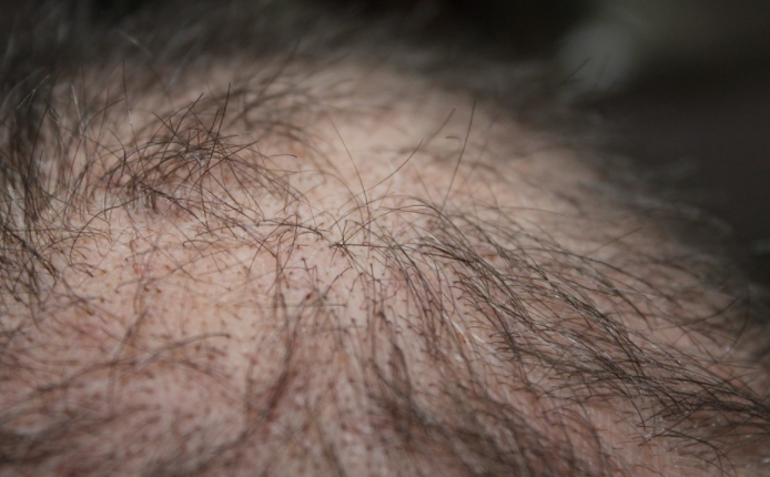 hair loss