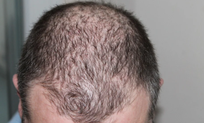 Hair loss treatment